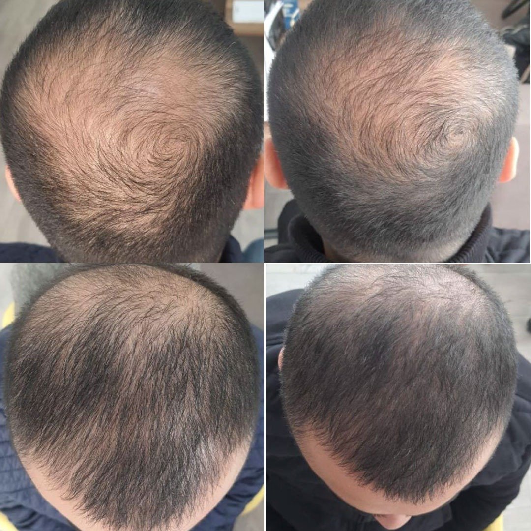 PRP-Behandlung Haarausfall Mannheim